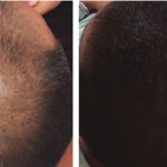 XL Hair -alopecia